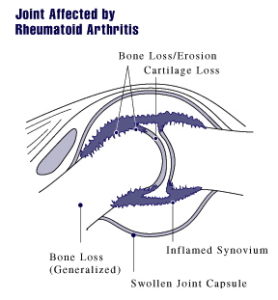 rheumatoid arthritis joint